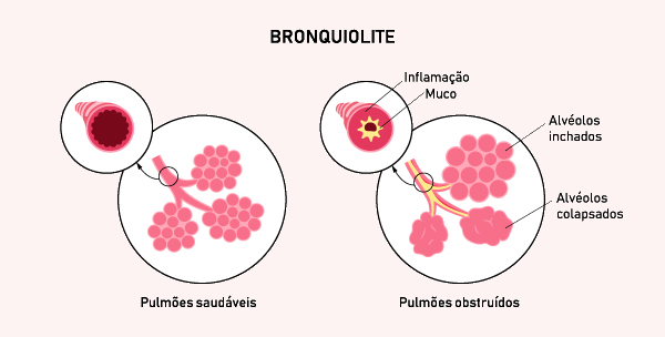 bronquiolite-–-brasil-escola