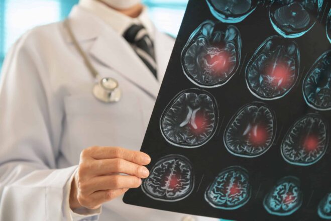 avc-mata-um-brasileiro-a-cada-seis-minutos;-80%-dos-casos-poderiam-ser-evitados